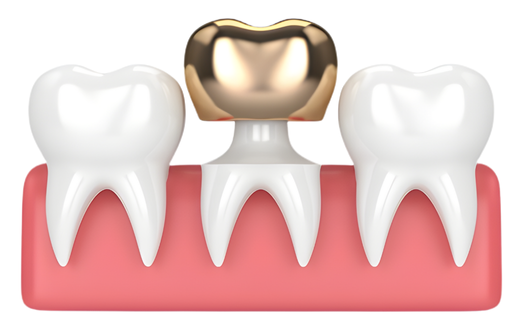 Dental Crowns