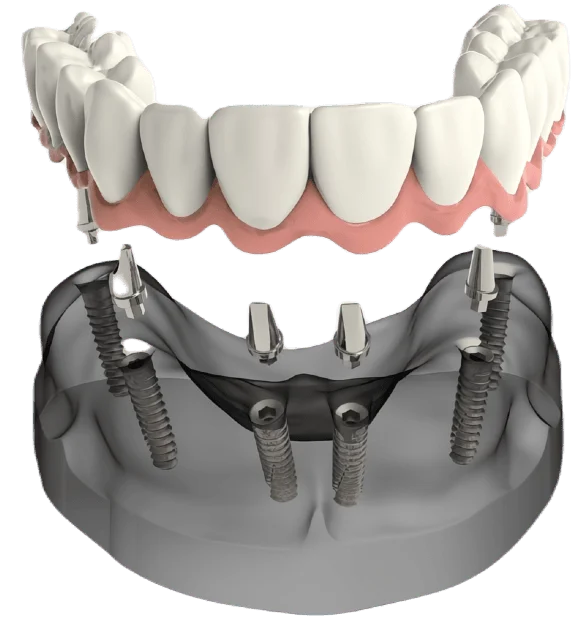 Surgical Guides Planning